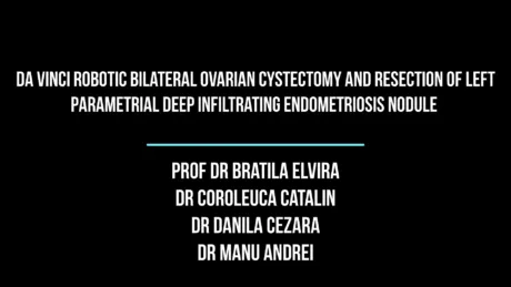 da Vinci Robotic Bilateral Ovarian Cystectomy and Resection of Left Parametrial Deep Infiltrating Endometriosis Nodule
